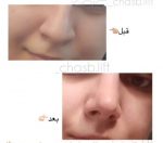 چسب لیفت بینی اورجینال - تصویر 3