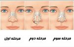 چسب لیفت بینی اورجینال - تصویر 4